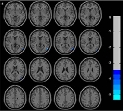 The local brain abnormalities in patients with Transient ischemic attack：A Resting-State fMRI Study